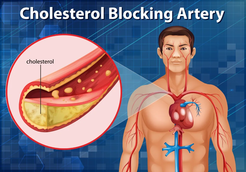कोलेस्ट्रॉल में अर्जुन छाल के फायदे | Benefits of Arjuna bark in cholesterol.